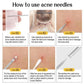 11Pcs Acne Blackhead Remover Tool