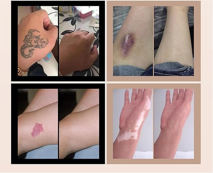 Tattoo & Scar Cover-Up Patches ( 6PC )