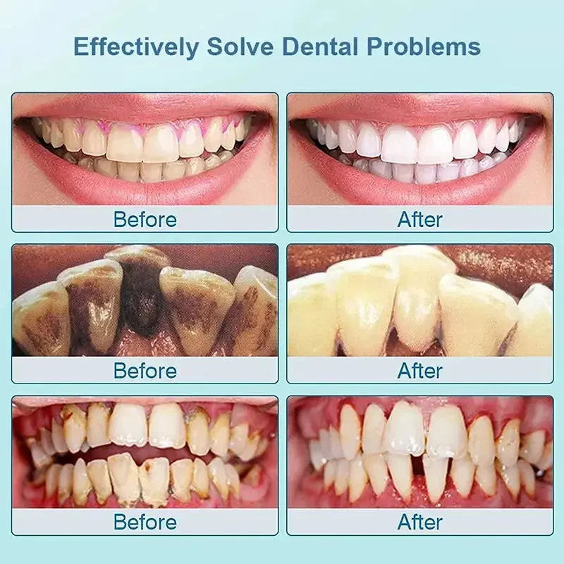 Dental Calculus Remover Whitening Toothpaste