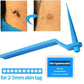 1 Set Skin Tag Removal Kit