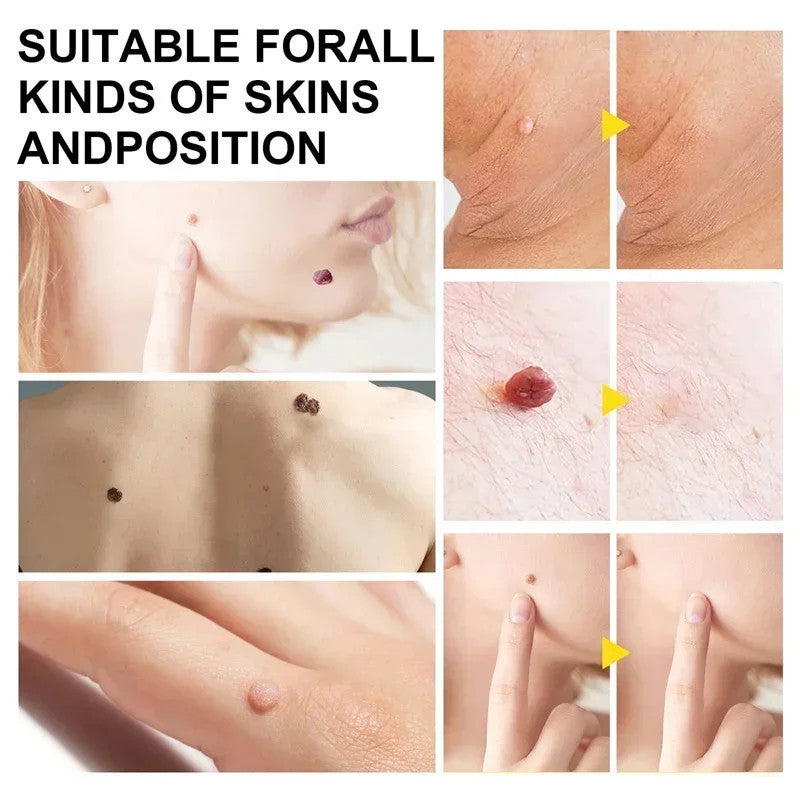 1 Set Skin Tag Removal Kit