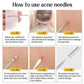 11Pcs Acne Needle Blackhead Clip Remover
