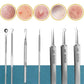 11Pcs Acne Needle Blackhead Clip Remover