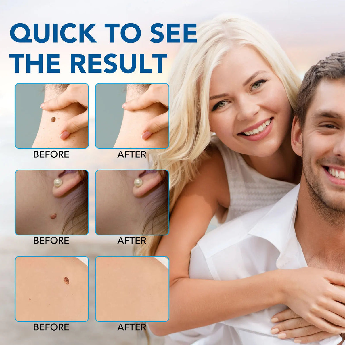 Skin Tag Mole Wart Spot Removal Tool