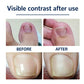 50pcs Nail Correction Stickers