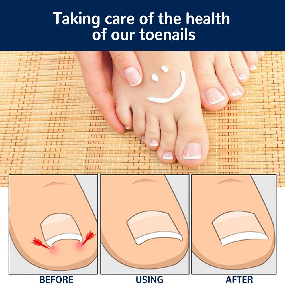 50pcs Nail Correction Stickers