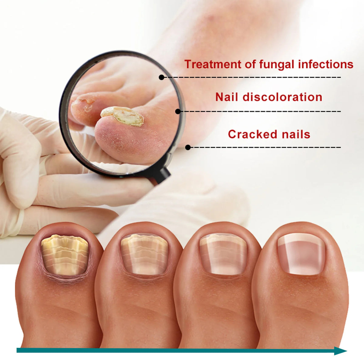 Ingrown Nail Correction Sticker 50pc