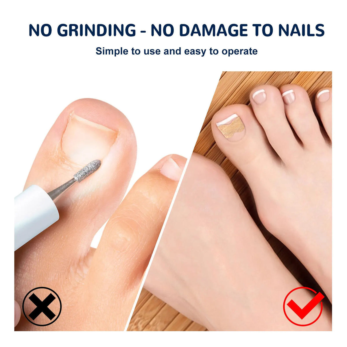 Ingrown Nail Correction Sticker 50pc