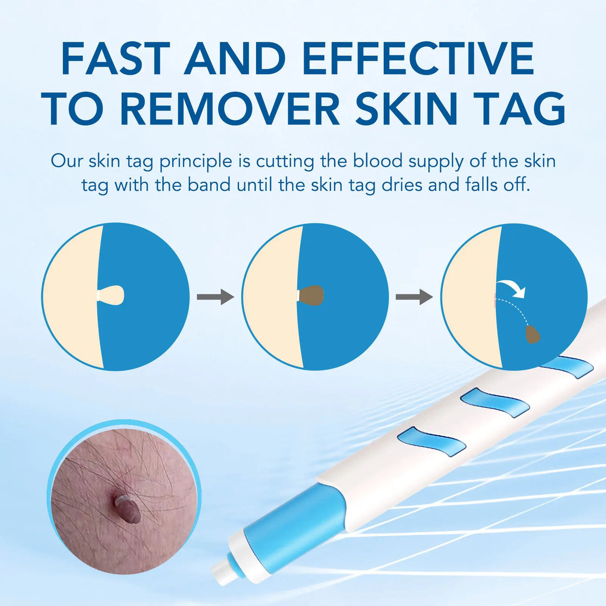 3 In1 Painless Auto Skin Tag Mole Wart Removal Kit