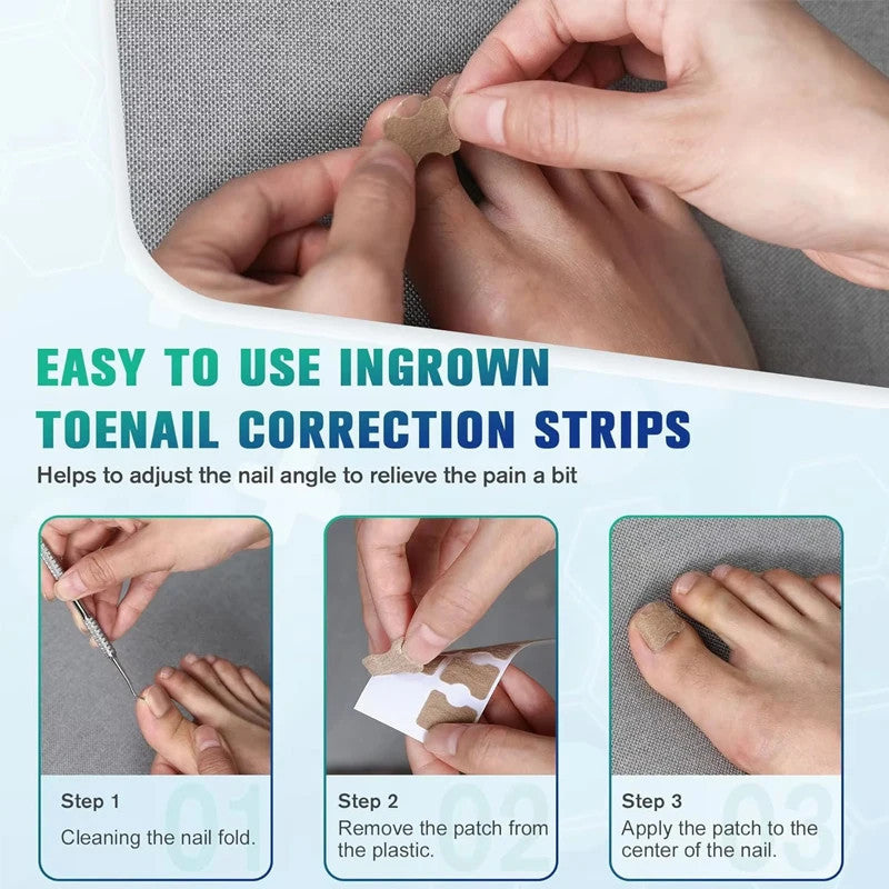 Nail Correction Stickers Ingrown Toenail Corrector Patches