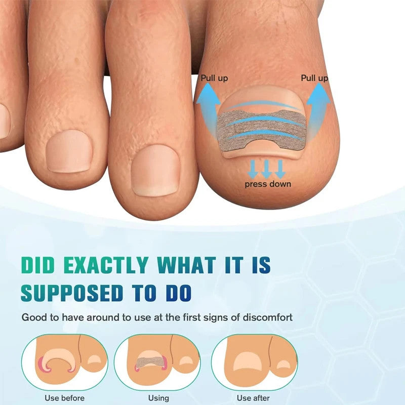 Nail Correction Stickers Ingrown Toenail Corrector Patches