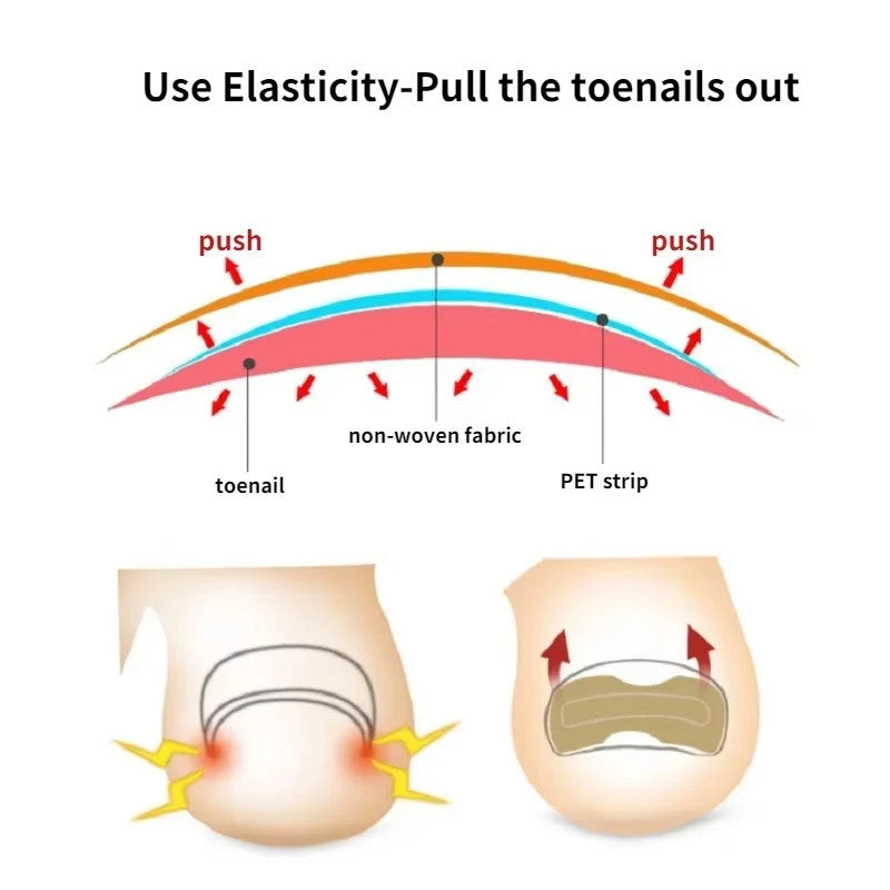 Nail Correction Stickers Ingrown Toenail Corrector Patches
