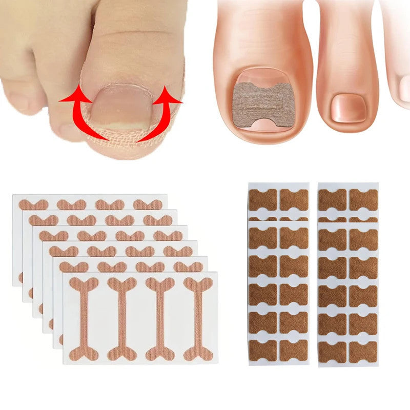 Nail Correction Stickers Ingrown Toenail Corrector Patches