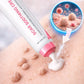 Scar Free Wart Removal Cream